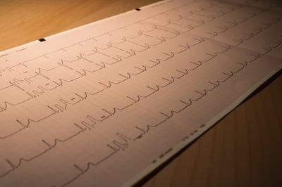 Cateterismo Cardiaco vs Cirugía de Corazón. Lo que necesitas Saber
